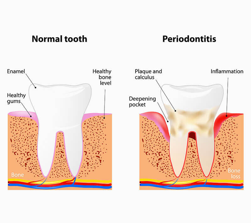 Normal Tooth Vs Periodontal disease