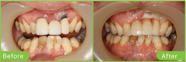 Brighton dental implants case 1