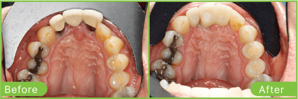 Brighton dental implants case 2