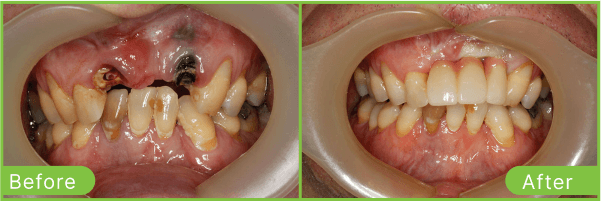 Brighton dental implants case 3