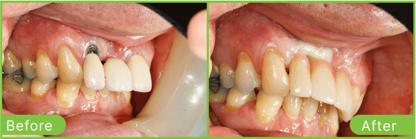 Brighton dental implants case 4