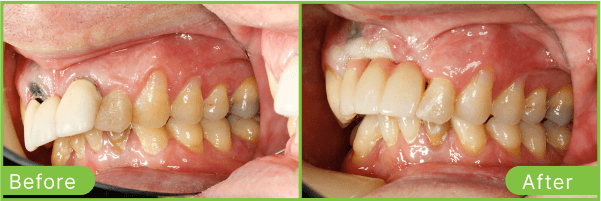 Brighton dental implants case 5