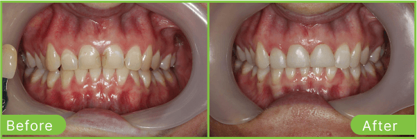Brighton teeth whitening case 1