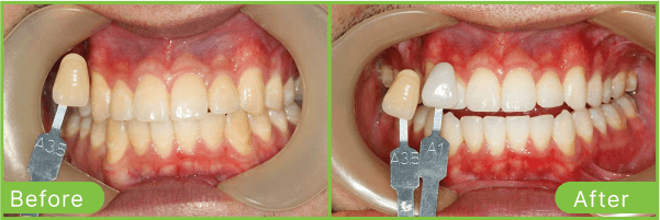 Brighton teeth whitening case 2