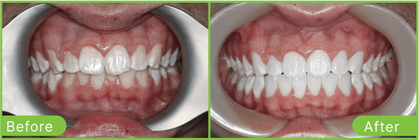 Brighton teeth whitening case 3